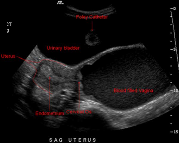 Urinary retention secondary to hematocolpos