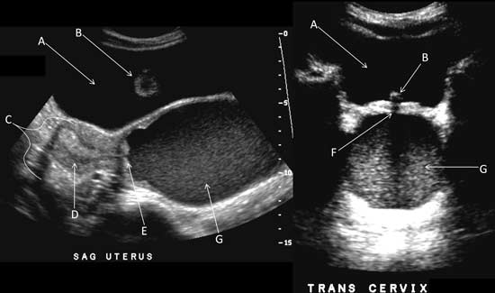 Pelvic images demonstrating hematometrocolpos