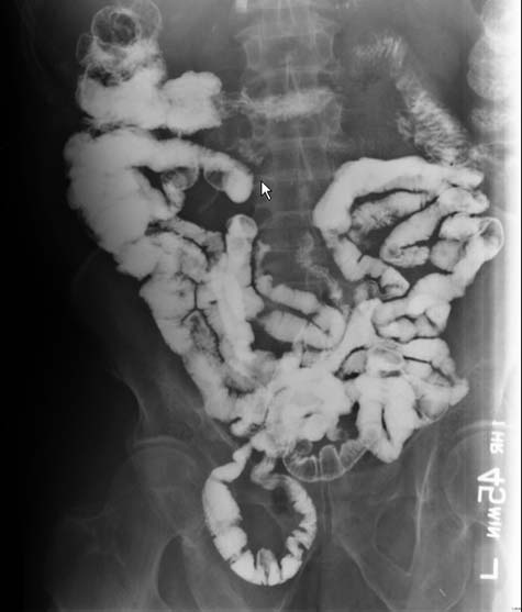 Radiografía del intestino delgado que muestra una hernia