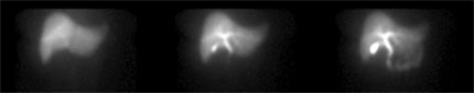 A normal hepatobiliary ('HIDA') scan