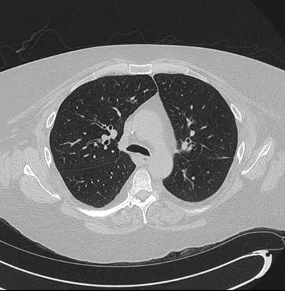 A normal high resolution CT image of the chest