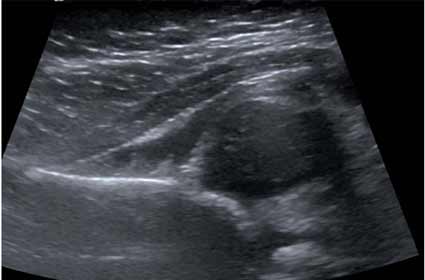 Ultrasound showing a dislocated hip in an infant