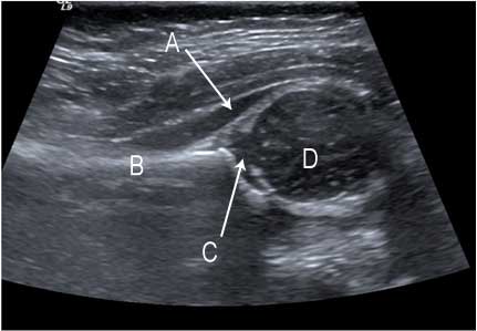Ultrasound showing a normal hip in an infant
