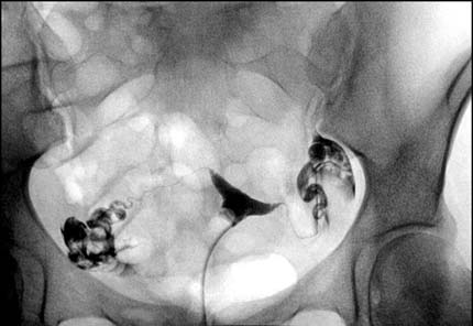 A normal hysterosalpingogram