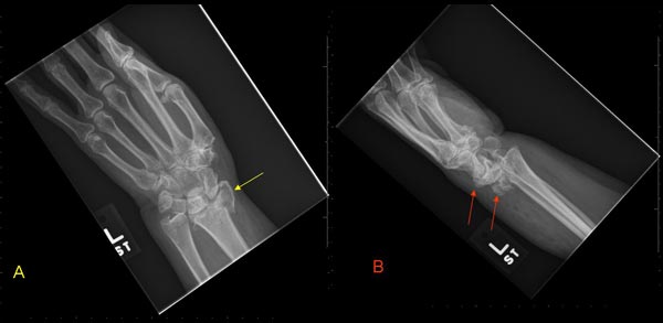 Radiografía del antebrazo izquierdo y la muñeca que muestra una fractura