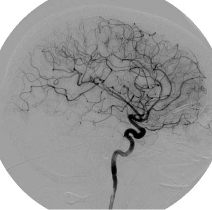 Internal carotid artery (ICA) angiogram
