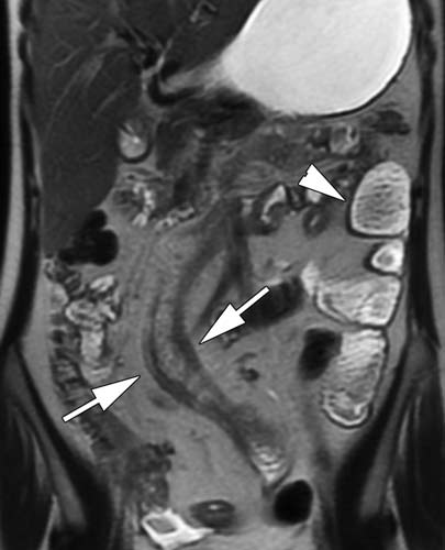 MR image of the iileum and cecum in a  patient with Crohn's disease.