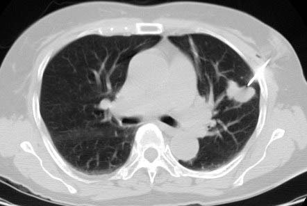  Imagen CT de biopsia pulmonar con aguja.