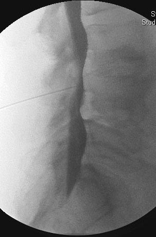 Myelography of lumbar spine