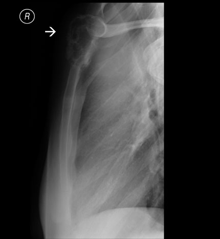 Radiografía de la pared torácica frontal superior de una paciente con cáncer