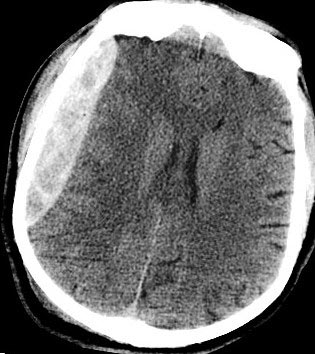 Head CT image showing a large blood clot.