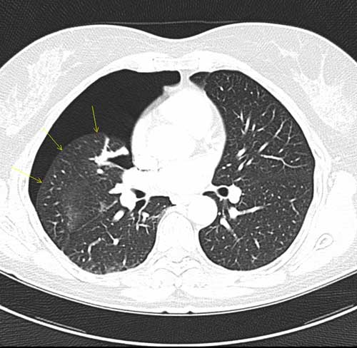 A CT image showing spontaneous pneumothorax