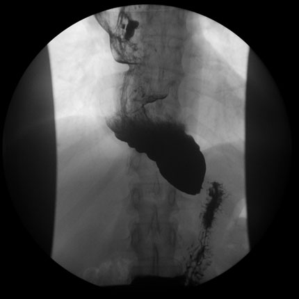 Dilated esophagus secondary to tight lower esophageal sphincter (achlasia)