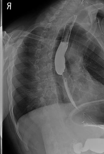 Image depicting esophageal narrowing due to cancer