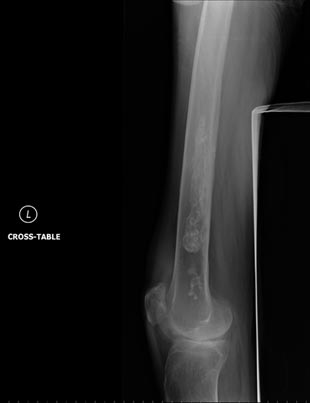 X-ray of the long bone in the thigh shows calcified medullary bone infarcts