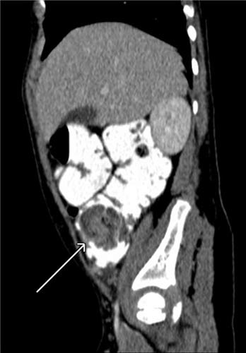 Una imagen de TC muestra un defecto de llenado en el colon proximal
