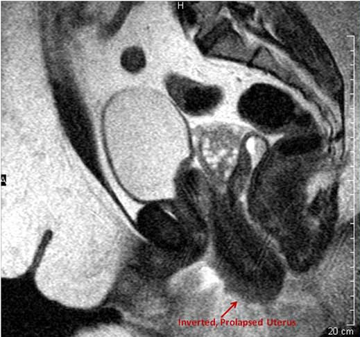 Image of an inverted, prolapsed uterus