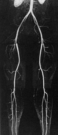 Un arteriograma por resonancia magnética de la pelvis y las extremidades inferiores hasta los tobillos