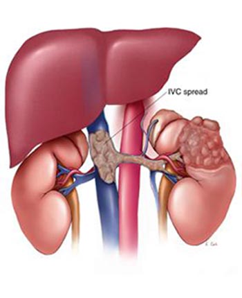 La ilustración representa un tumor esparcido en la Vena Cava Inferior que puede tratarse con la colocación y remoción de un Filtro de Vena Cava.