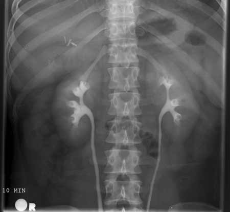 Una imagen de rayos X de IVP de la parte superior del abdomen