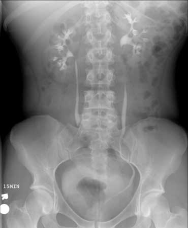 An IVP x-ray image of the whole abdomen