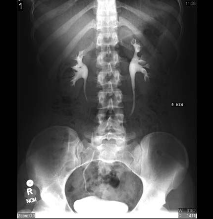 IVP image. Contrast is seen in the kidneys, ureters, and bladder.