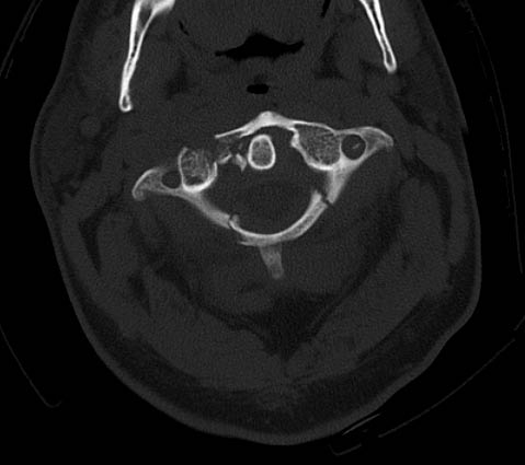 Una imagen de TC de la columna cervical que muestra una fractura