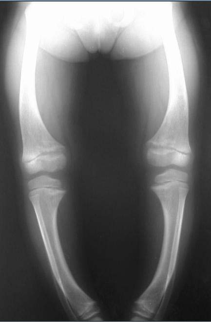 X-ray of a child with rickets