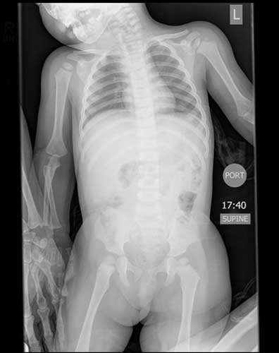 Kiddiegram del tórax y el abdomen de un niño