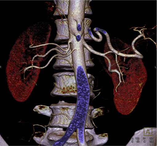 Imagen de angiografía por CT del riñón.