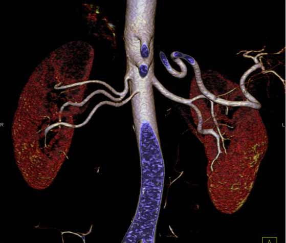  Imagen de angiografía por CT del riñón.