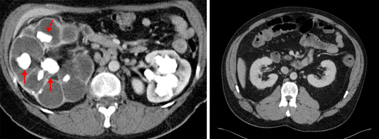  Imágenes de CT que muestran cálculos renales grandes y riñones normales.