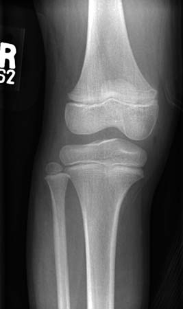 Una radiografía de una rodilla normal en un niño (vista antero/posterior)