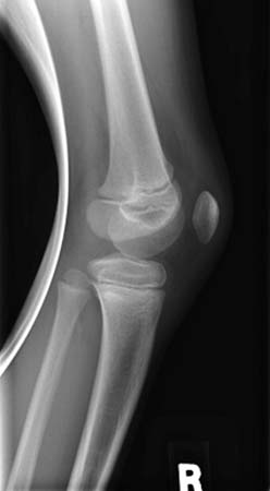 An x-ray of a normal knee in a child (lateral view).