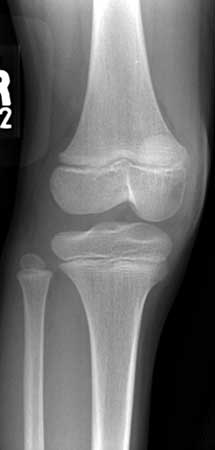 An x-ray of a normal knee in a child (vista oblique)