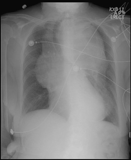Radiografía de tórax que muestra un gran aneurisma de la aorta torácica