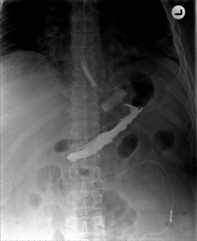 X-ray image: upper abdomen