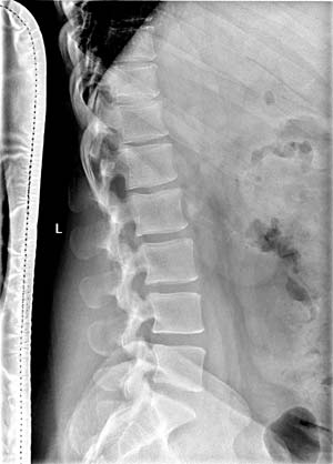 Apariencia normal de la columna lumbosacra