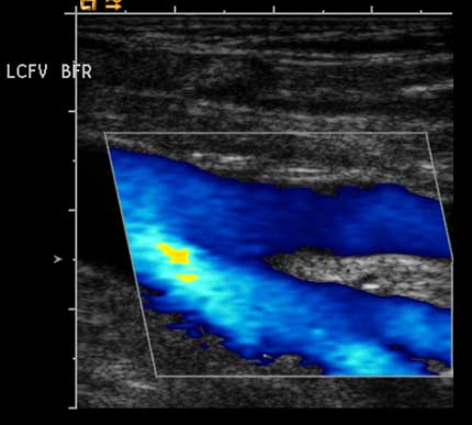 Imagen de ultrasonido de la vena femoral y sus dos afluentes principales