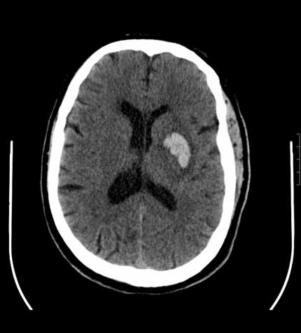 Acute intraparenchimal hemorrhage