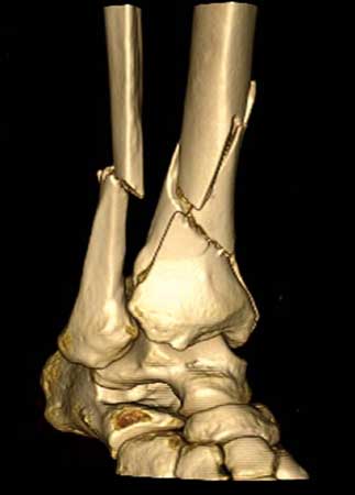  Imagen CT en 3-D que muestra fracturas de hueso de la pierna.