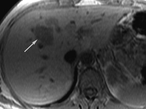 MRI of the liver showing a low-signal intensity lesion. 
