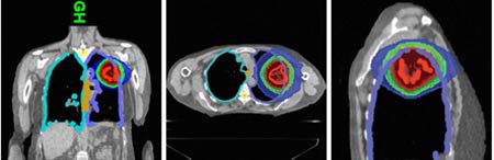 images of radiosurgery and radiotherapy being delivered to part of the lung.