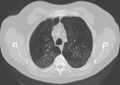 CT scan showing severe emphysema.