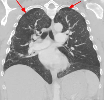 CT scan showing emphysema.