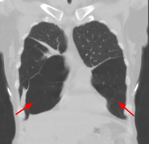  Tomografía computarizada del pulmón que muestra enfisema.