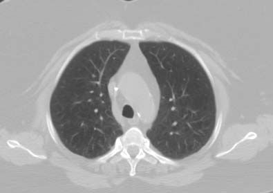CT scan showing mild emphysema.