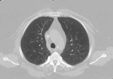 Tomografía computarizada que muestra enfisema leve.
