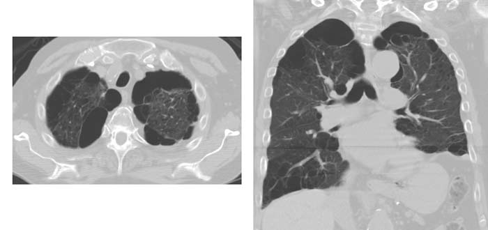 Imágenes de CT del pulmón que muestran enfisema severo.