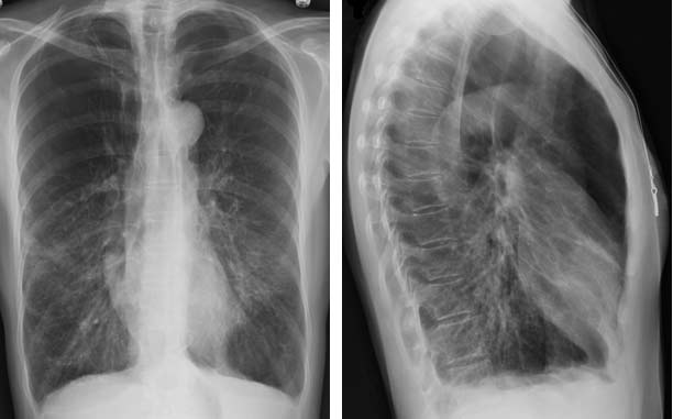  Radiografía de tórax que muestra enfisema grave.